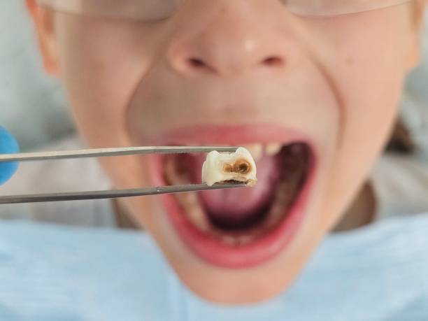 Best Chipped Tooth Repair Near Me  in Louisville, CO